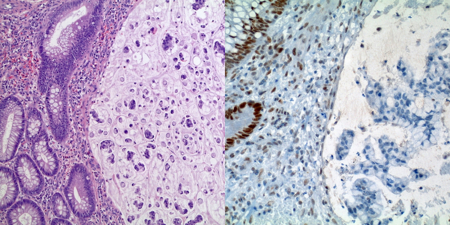 (links) Muzinöses Adenokarzinom des Kolons (H&E) (rechts) Expressionsverlust eines Mismatch-Repair-Proteins in den Tumorzellen (rechter Bildrand) bei erhaltener nukleärer Reaktivität im Normalgewebe (linker Bildrand) (Immunhistologie für MLH1)