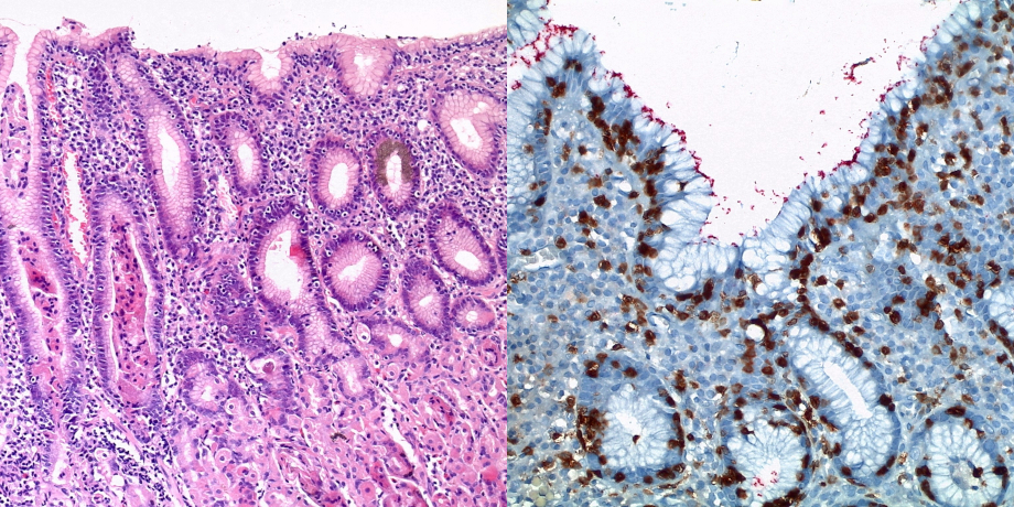 (links) Helicobacter pylori-assoziierte lymphozytäre Gastritis der Magenkorpusschleimhaut (H&E) (rechts) Immunhistologische Doppelmarkierung: Helicobacter-Keime rot, CD3-positive intraepitheliale T-Lymphozyten braun