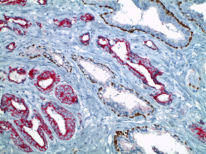 Prostatakarzinom (Immunhistologische Doppelmarkierung: Basalzellen p63 nukleär braun, Tumorzellen P504S zytoplasmatisch rot)