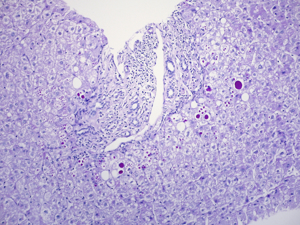 Globuläre Einschlüsse in periportalen Hepatozyten bei Alpha-1-Antitrypsin-Mangel (PAS-Färbung)