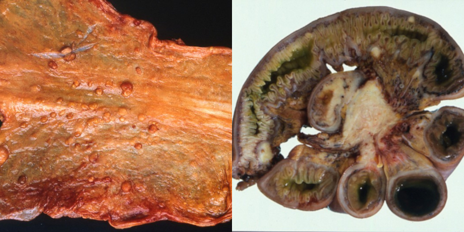 Neuroendokrine Tumoren (NET) des Gastrointestinaltrakts: (links) Multiple benigne gastrinabhängige ECL-Zell-NET (frühere Bezeichnung „Karzinoide“) im Magenkorpus und -fundus bei chronisch-atropher Gastritis (rechts) Maligner NET („hochdifferenziertes neuroendokrines Karzinom“) des Dünndarms (Ileums) mit metastatischen Absiedlungen im mesenterialen Fettgewebe