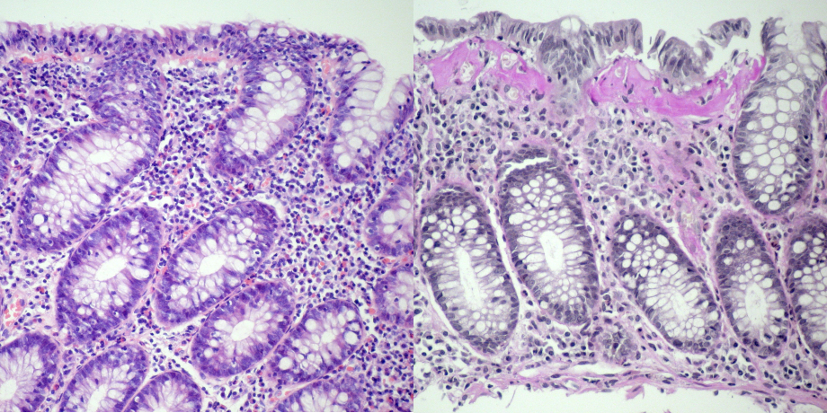 (links) Lymphozytäre Kolitis (H&E) (rechts) Kollagene Kolitis (van Gieson-Färbung)