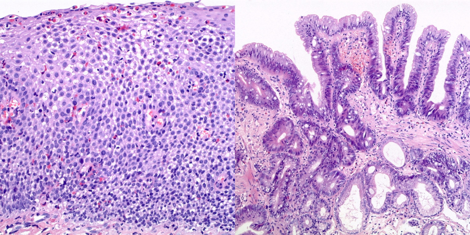 (links) Eosinophile Ösophagitis (H&E) (rechts) Barrett-Ösophagus mit leichter Dysplasie (Synonym: geringgradige intraepitheliale Neoplasie) (H&E)