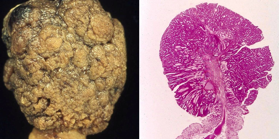 (links) Endoskopisches Schlingenresektat eines gestielten tubulären Dickdarmschleimhautadenoms (rechts) Lupenhistologisches Bild (H&E) des gestielten Dickdarmschleimhautadenoms